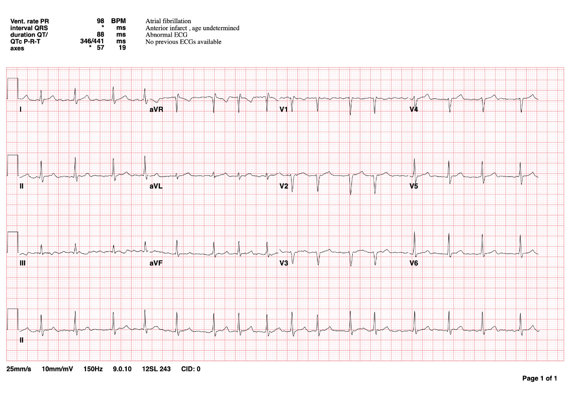 EKG tracing of atrial fibrillation